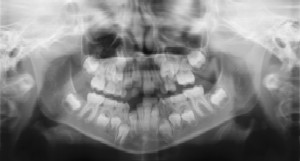 Dental Radiographs (X-Rays) at the Pediatric Dentist Office in Casa Grande, Mesa and Chandler, AZ