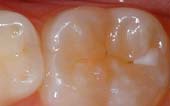 Tooth Before Sealant Applied at the Pediatric Dentist Office in Casa Grande, Mesa and Chandler, AZ