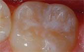 Tooth After Sealant Applied at the Pediatric Dentist Office in Casa Grande, Mesa and Chandler, AZ